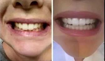 网红牙齿最丑的